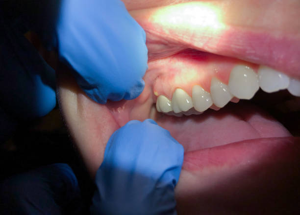 Best Emergency Tooth Extraction in Lake Hallie, WI
